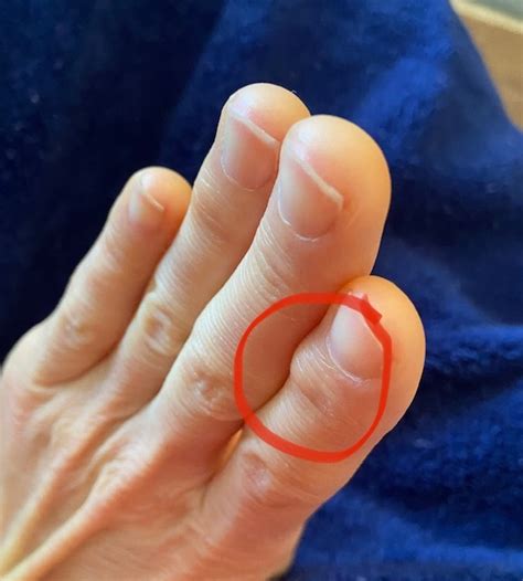 Bone Spur Or Hard Growth In Knuckle