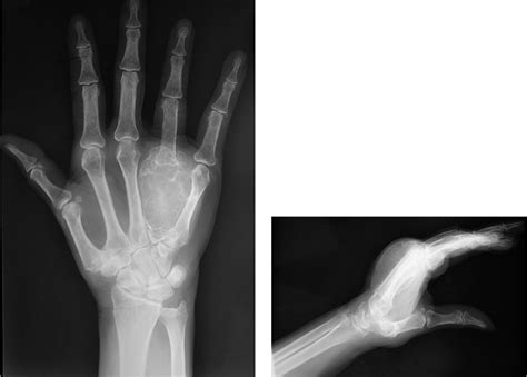 Figure 2 From Reconstruction Of An Entire Metacarpal And