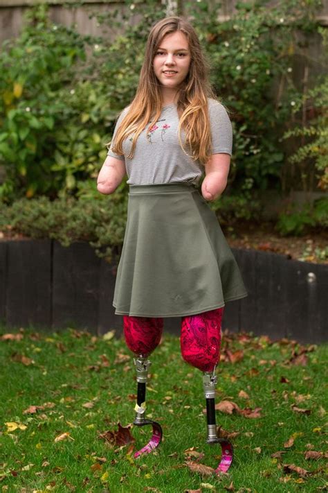 Checkout This Young Teenage Girl Who Has Amputated Limbs And Still Get
