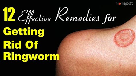 12 Effective Remedies For Getting Rid Of Ringworm Healthspectra Youtube