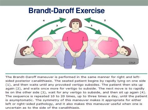 Benign Paroxysmal Positional Vertigo Bppv Cause Autos Post