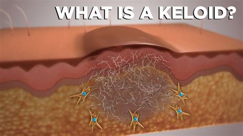 What Is A Keloid Youtube