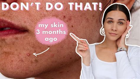Skincare Mistakes That Make Your Acne Worse Youtube