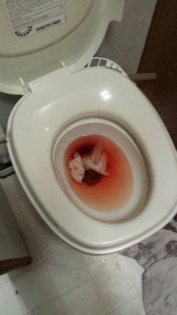 For The Past Five Months When I Poop I Bleed I Dont Know If My Poop