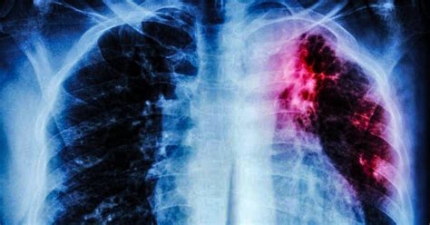 Tuberculosis is a dangerous bacterial infection that attacks your lungs. Detectado caso de tuberculosis en la provincia de Cádiz