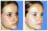 Photos of Cosmetic Surgery In Thailand Packages