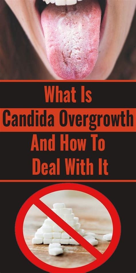 what is candida overgrowth and how to deal with it health remedies 365 candida overgrowth