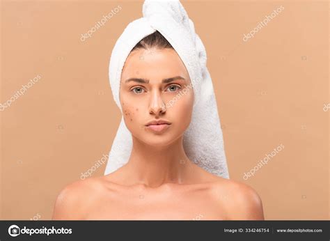 Nude Girl Towel Acne Face Isolated Beige Stock Photo Igorvetushko