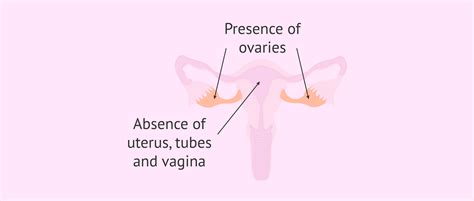 Mullerian Agenesis