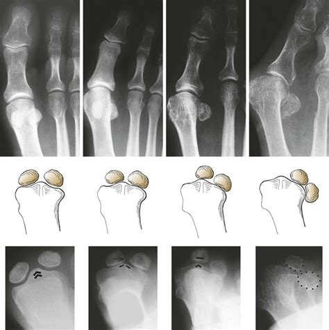 Sesamoids And Accessory Bones Of The Foot Musculoskeletal Key