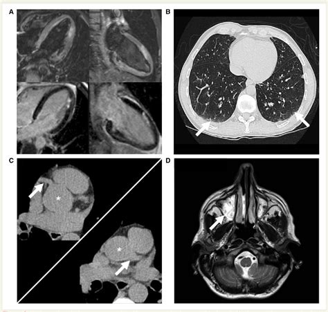 Figure 2 From Eosinophilic Granulomatosis With Polyangiitis Churg