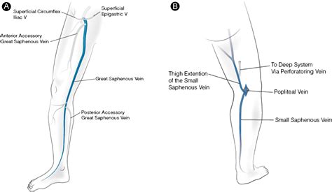 Superficial Veins Treatment Options And Techniques For Saphenous Veins