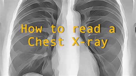 How To Read A Chest X Ray Youtube