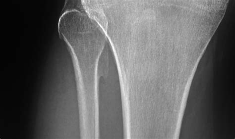 Daily Dose Sessile Osteochondroma