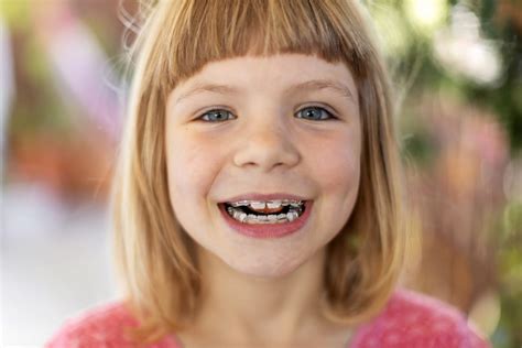The Benefits Of Wearing Braces As A Child Versus An Adult
