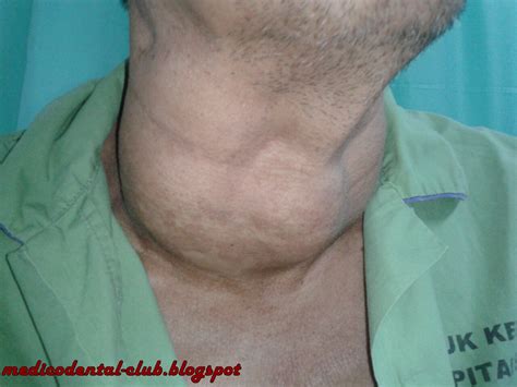Knots In Neck Images Frompo 1