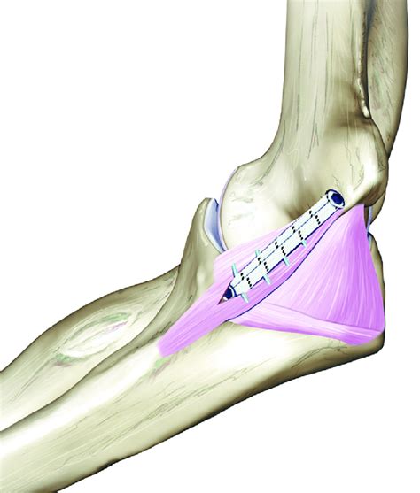 Ulnar Collateral Ligament Rehabilitation