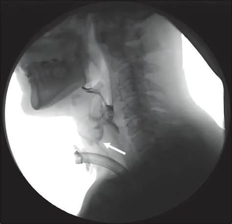 Frontiers | Biomechanical mechanism of reduced aspiration by the Passy
