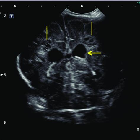 Transcranial Ultrasound Day 2 Coronal Plane Cystic Lesion In