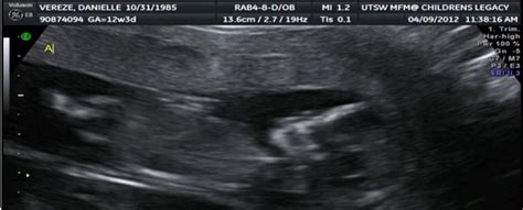Vereze Triplets Ultrasound Pictures