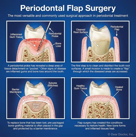 Periodontal Flap Surgery Coastal Periodontics And Implant Dentistry P