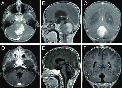 Preoperative And Postoperative Enhanced Magnetic Resonance Imaging In A