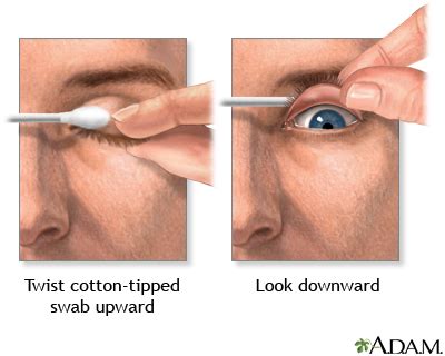 If you have an eyelid bump, it might be a stye, chalazion, xanthelasma, or milia. Eye - foreign object in
