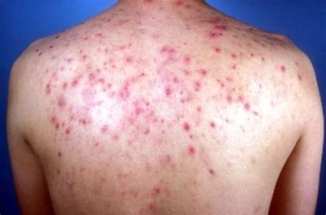 10 Tips On How To Cure Back Acne Hubpages