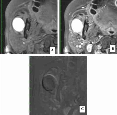 Pre And Postcontrast Enhanced T1w Mri Images With Fat Suppression A