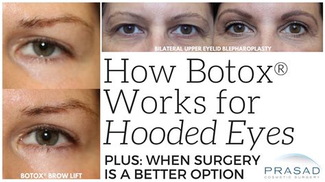 How Botox Can Help With Slightly Hooded Eyes And When Eyelid Surgery