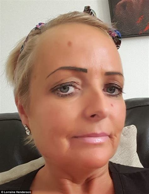 Mother Who Used Sunbeds Shares Shocking Picture Of Skin Cancer Scar