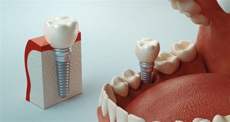 ¿cómo Se Realiza Una Intervención De Implantes Dentales