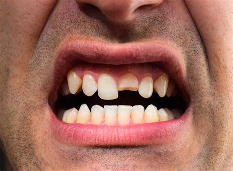 What Should I Do After Breaking A Tooth Cirocco Dental Center