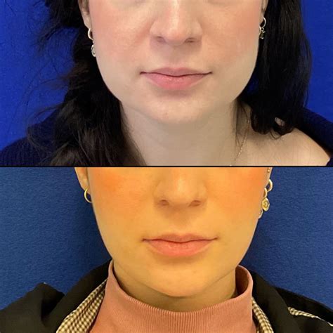 Masseter Botox Maia Plastic Surgery
