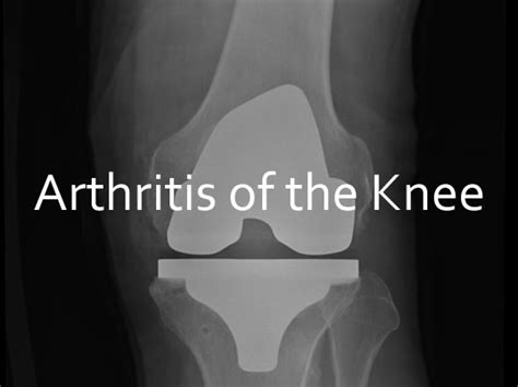 Arthritis In Knee Canberra Orthopaedicscanberra Orthopaedics