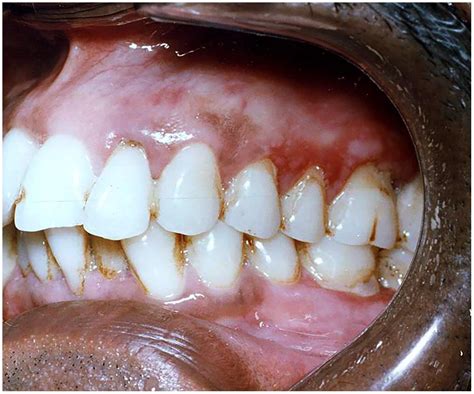 Frontiers Clinical Appearance Of Oral Candida Infection And