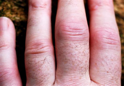 Rheumatoid Arthritis Fingers An Old Photo Before My First Flickr