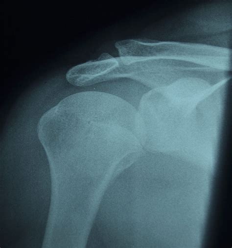 Fractures Of The Lesser Tuberosity Of The Humerus Jbjs