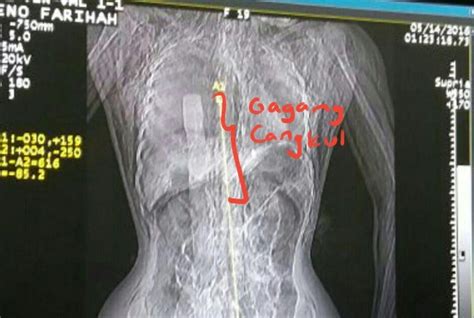 Ini Hasil Rontgen Gagang Cangkul Di Tubuh Eno Korban Pembunuhan Sadis