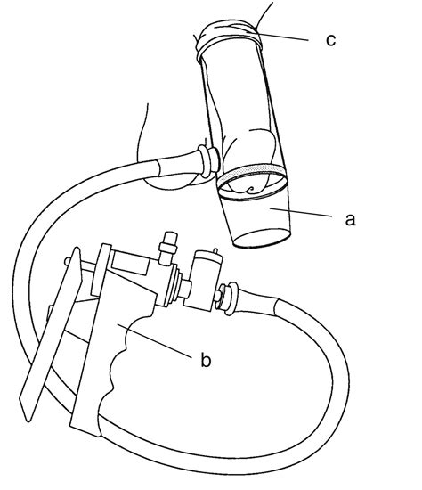 A Vacuum Constrictor Device Placed Around The Penis Media Asset NIDDK