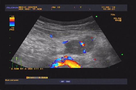 Vietnamese Medic Ultrasound Case 206 Epigastric Mass Post
