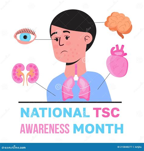Tuberous Sclerosis Awareness Month Is Celebrated In Usa Patient With Rash Pimples Are Shown