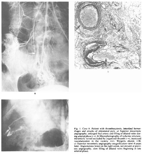 Figure 1 From Angiography In Angiomatous Lesions Of The