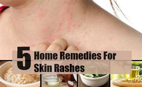 5 Home Remedies For Skin Rashes Natural Treatments