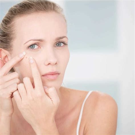 2023 Acne Scars How To Get Rid Of Them