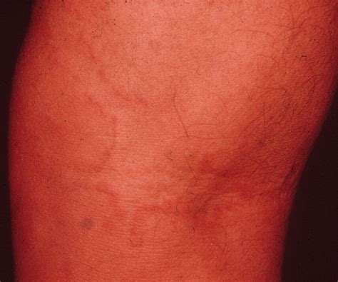 Arcuate Annular And Polycyclic Inflammatory And Infectious Lesions