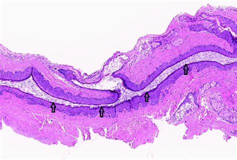 Histological Finding Of Nasal Dermoid Cyst Hematoxylin Eosin The