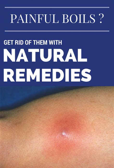 Painful Boils Get Rid Of Them With Natural Remedies Natural Remedies For Boils Boils