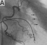 The Pump and the Tubes: The Third Coronary Artery? (the conus artery)