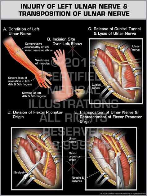 Injury Of Left Ulnar Nerve And Transposition Of Ulnar Nerve